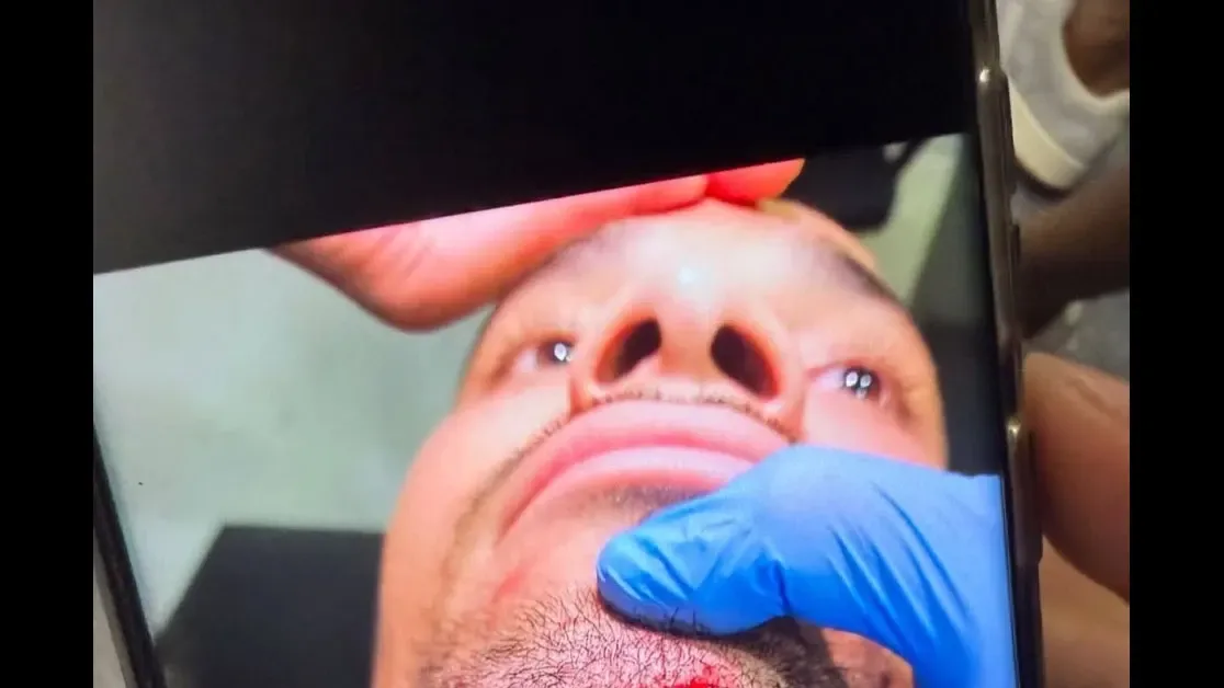[Conteúdo sensível] Montoro compartilha foto de corte profundo no queixo de Warleson em Botafogo x Cienciano